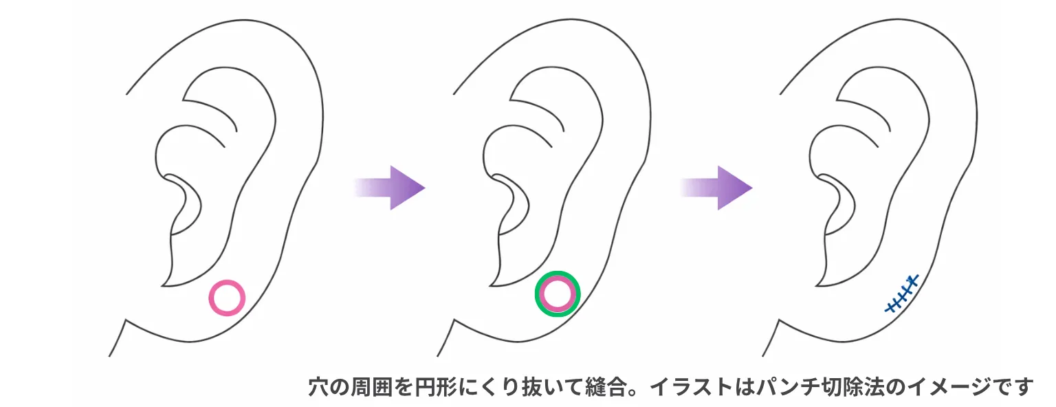 拡張したピアス穴の修正方法解説
