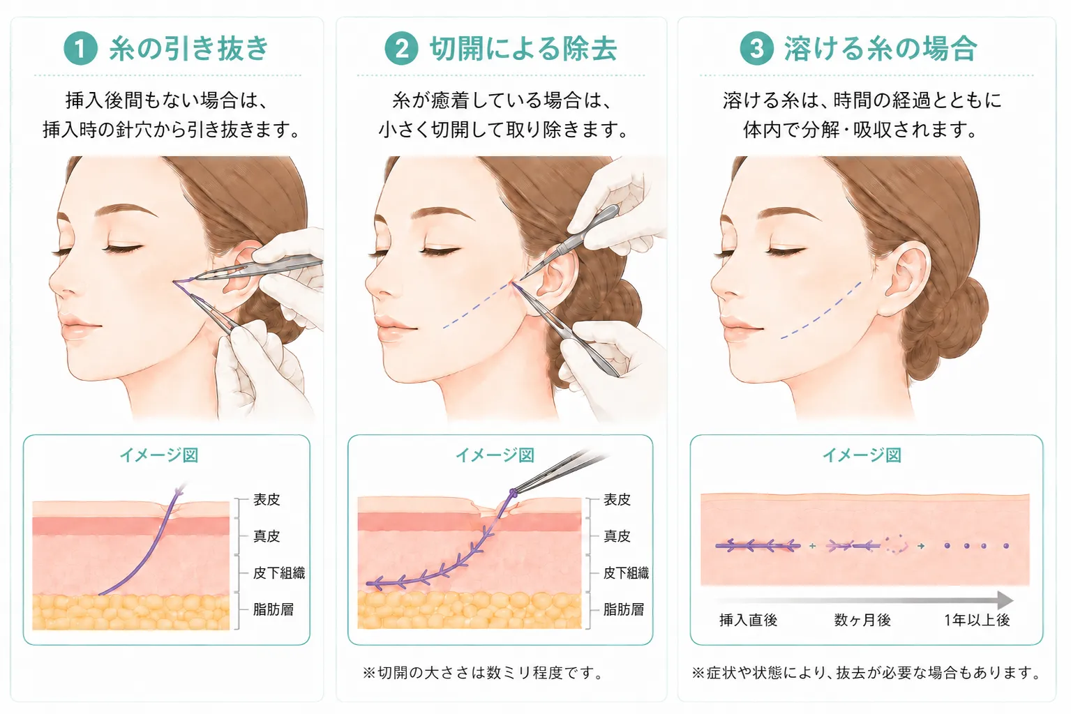 糸リフト抜去の方法説明画像