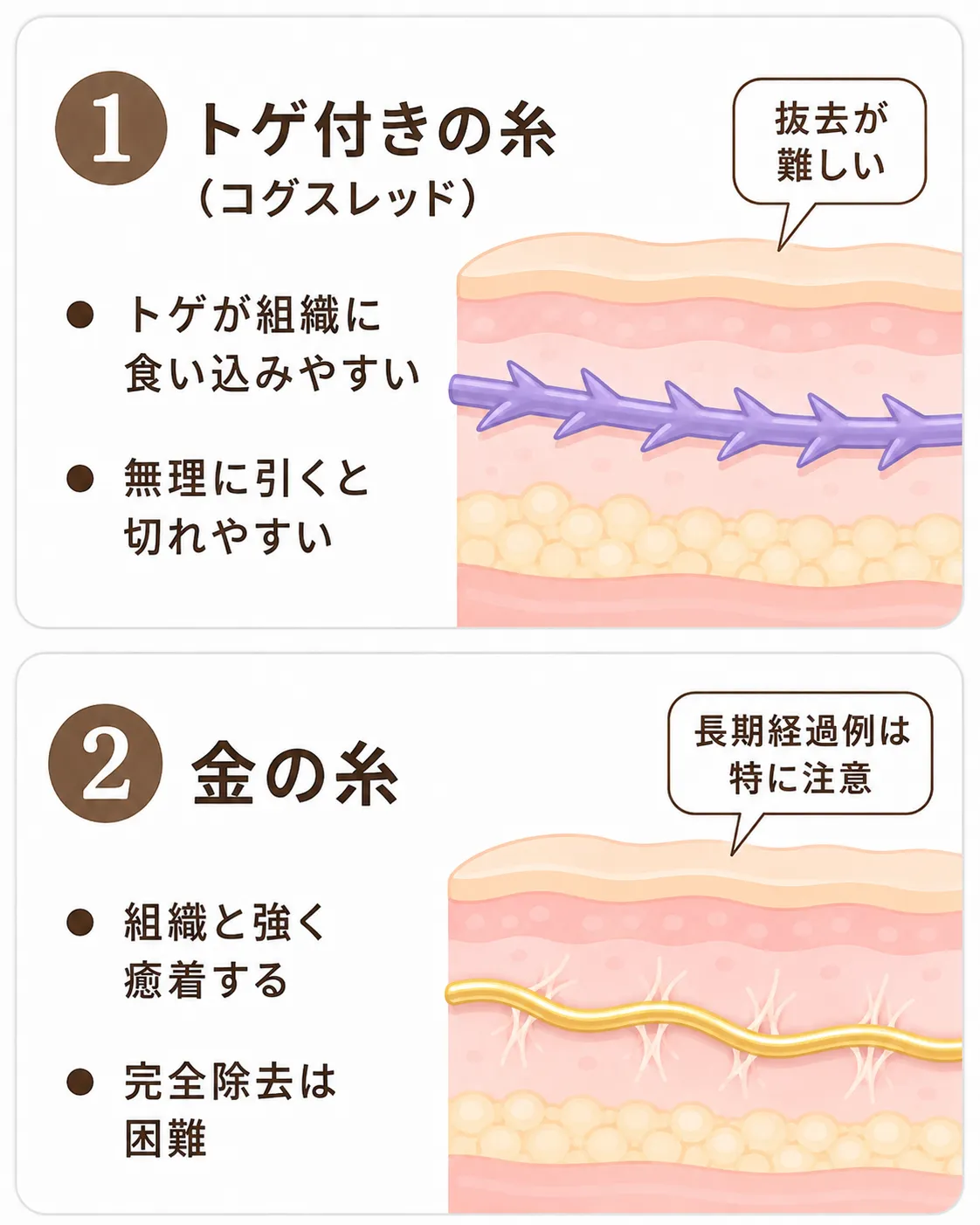 糸リフト抜去│抜糸が難しい糸の種類説明画像
