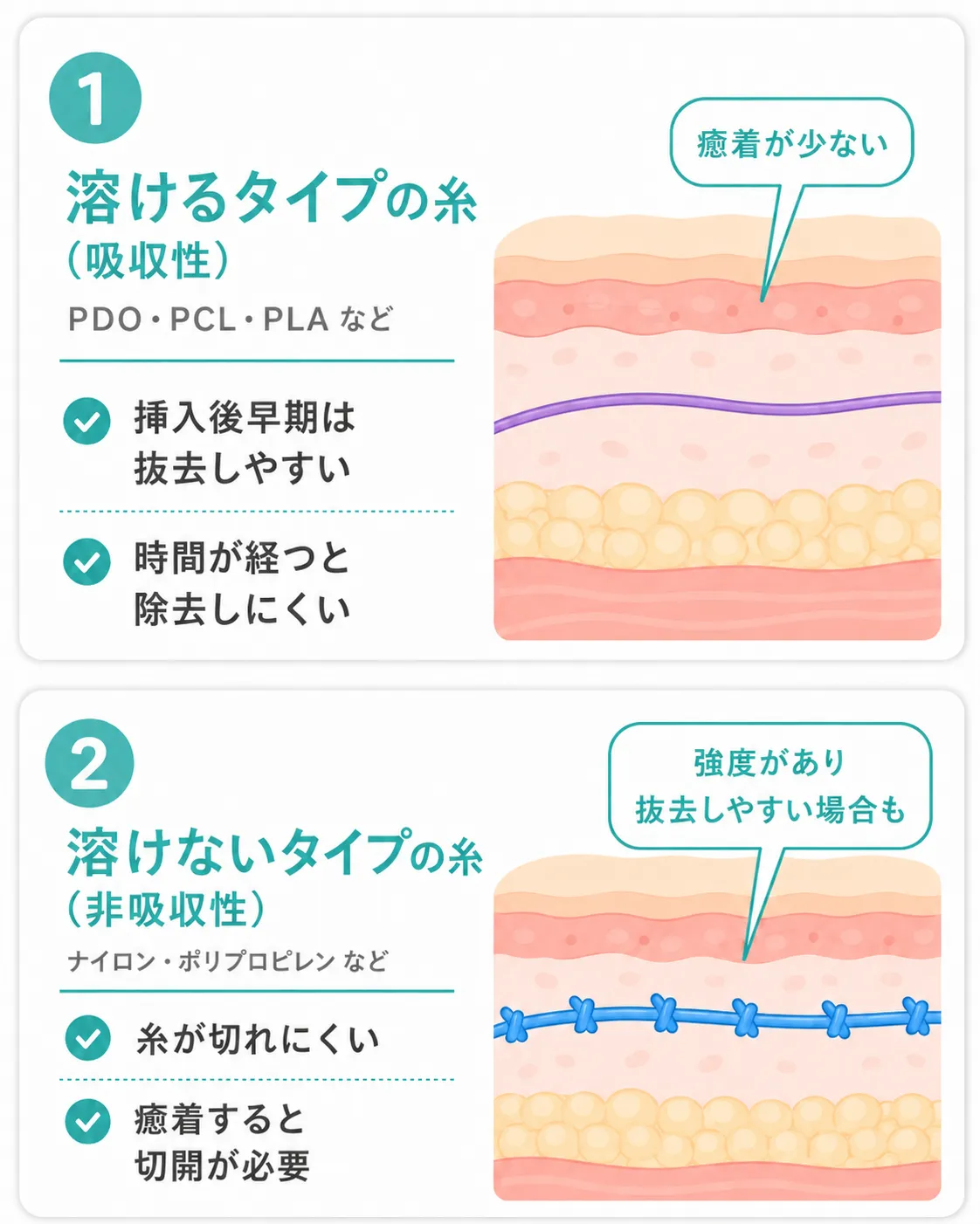 糸リフト抜去│抜糸しやすい糸の種類説明画像