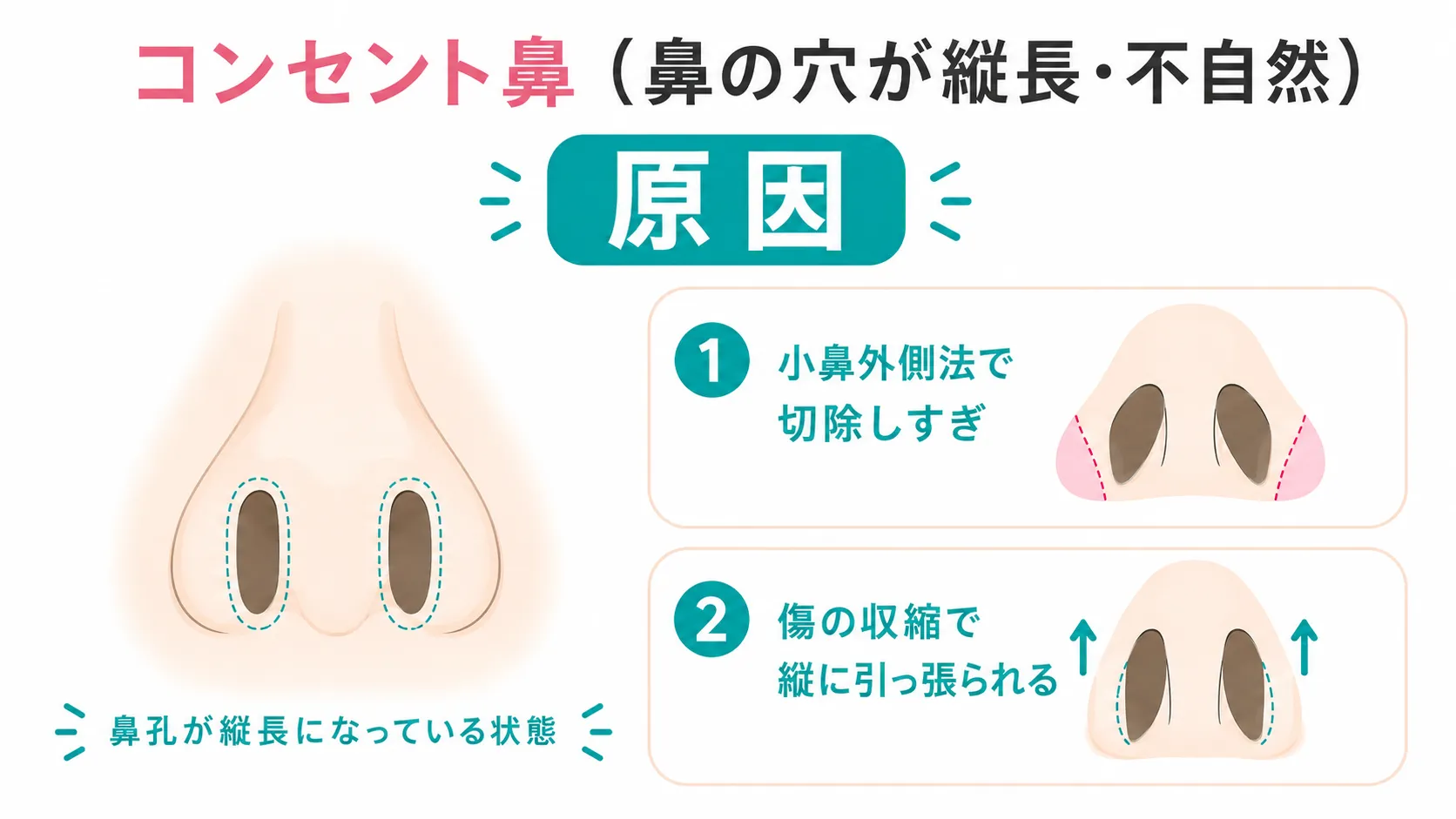 小鼻縮小修正│コンセント鼻の症状と原因イラスト
