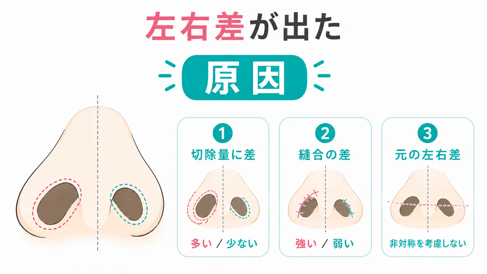 小鼻縮小修正│左右差の症状と原因イラスト