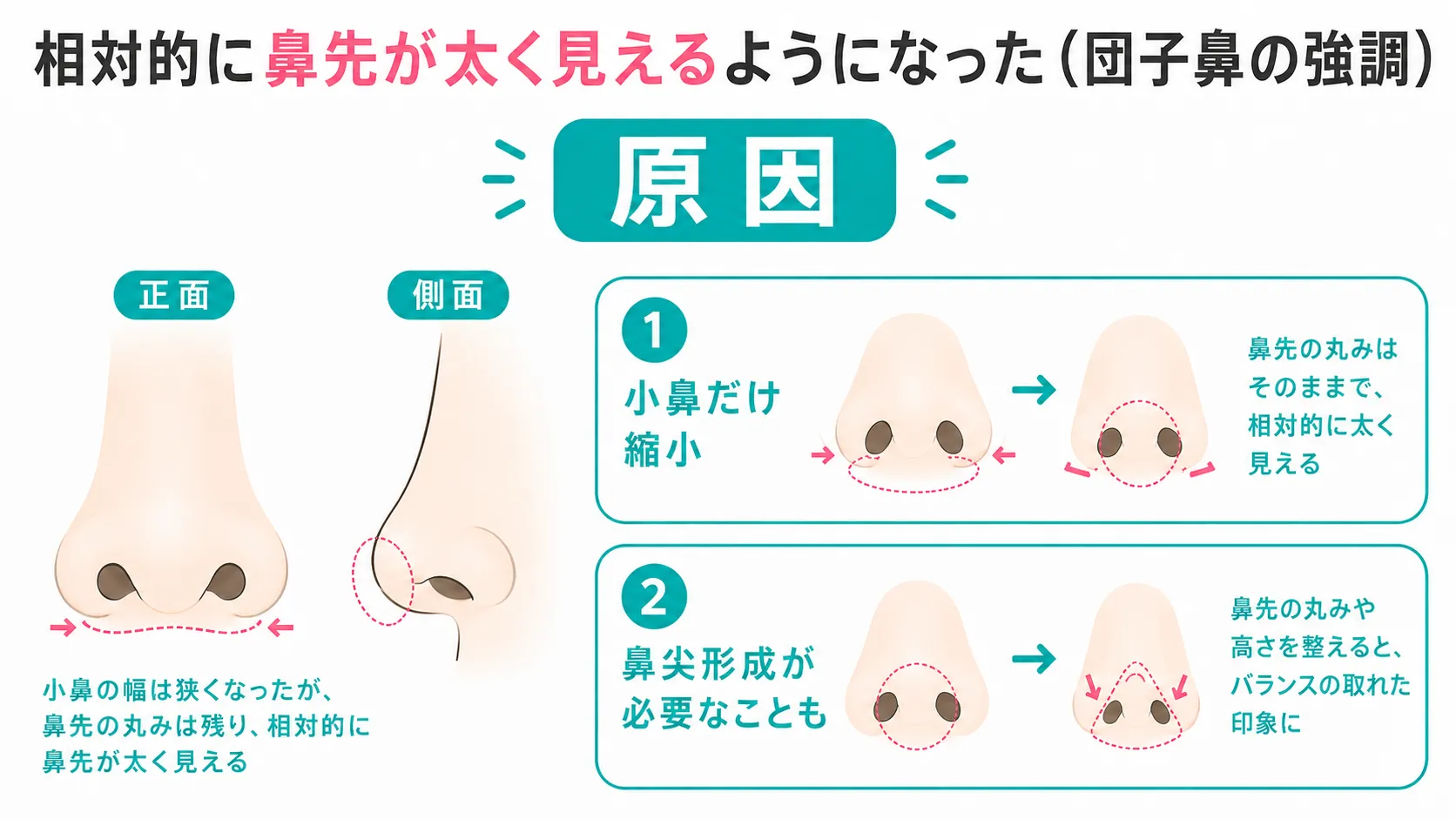 小鼻縮小修正│鼻先の太さの症状と原因イラスト