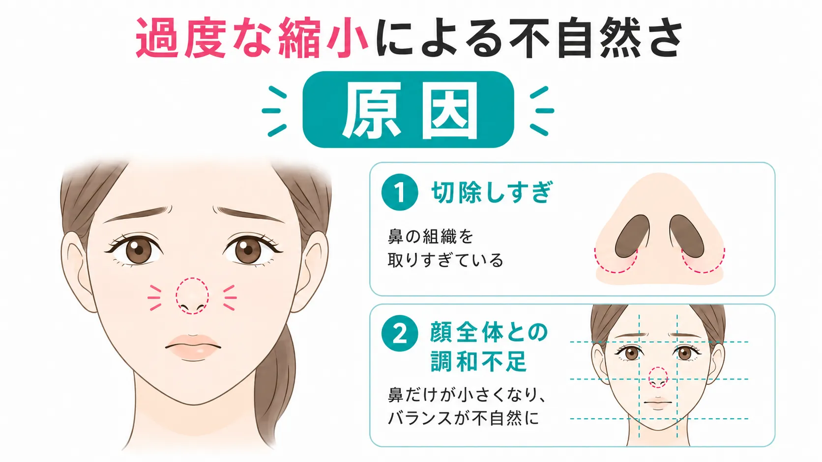 小鼻縮小修正│過度な縮小の症状と原因イラスト