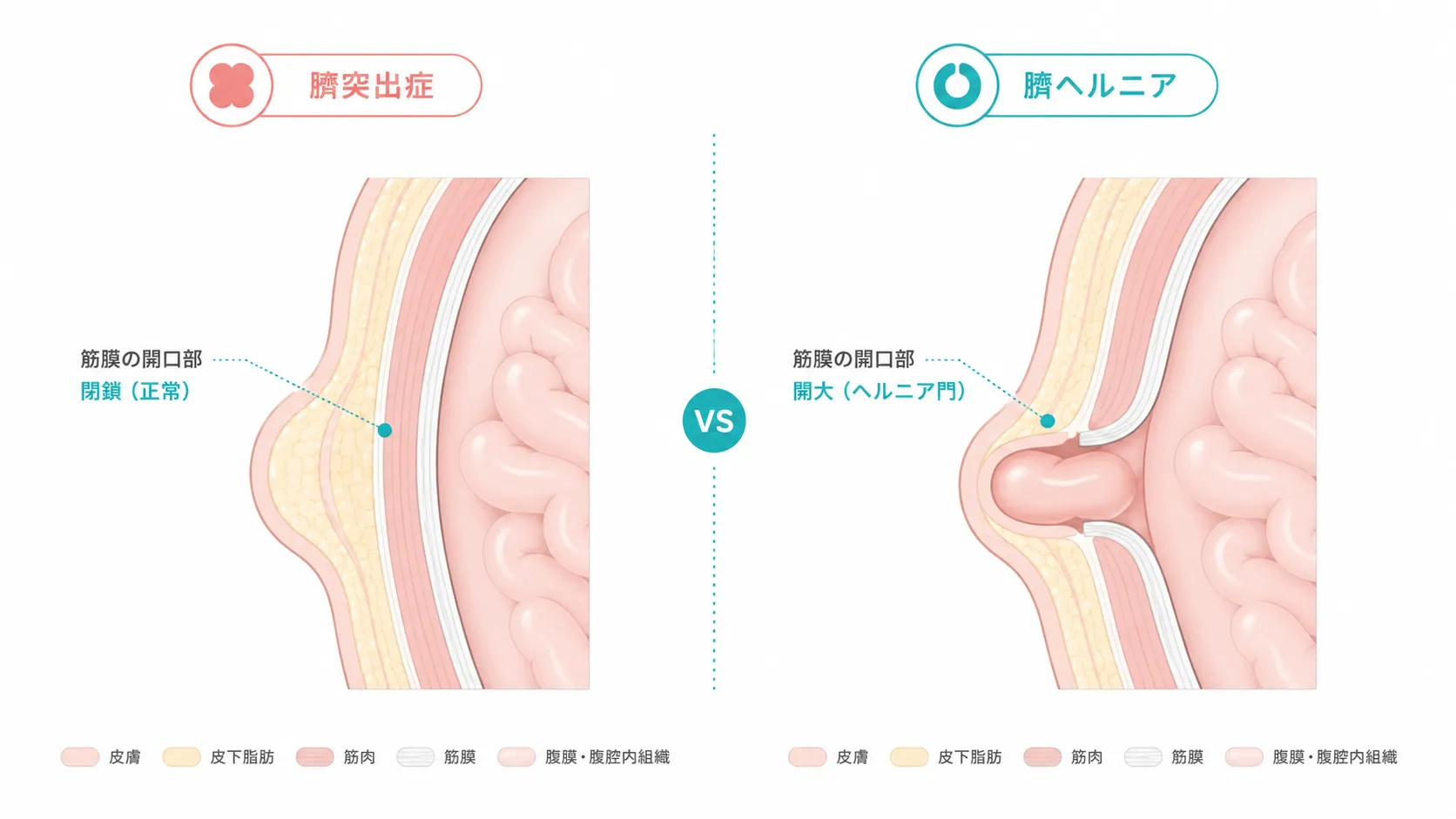 臍突出症と臍ヘルニアの比較